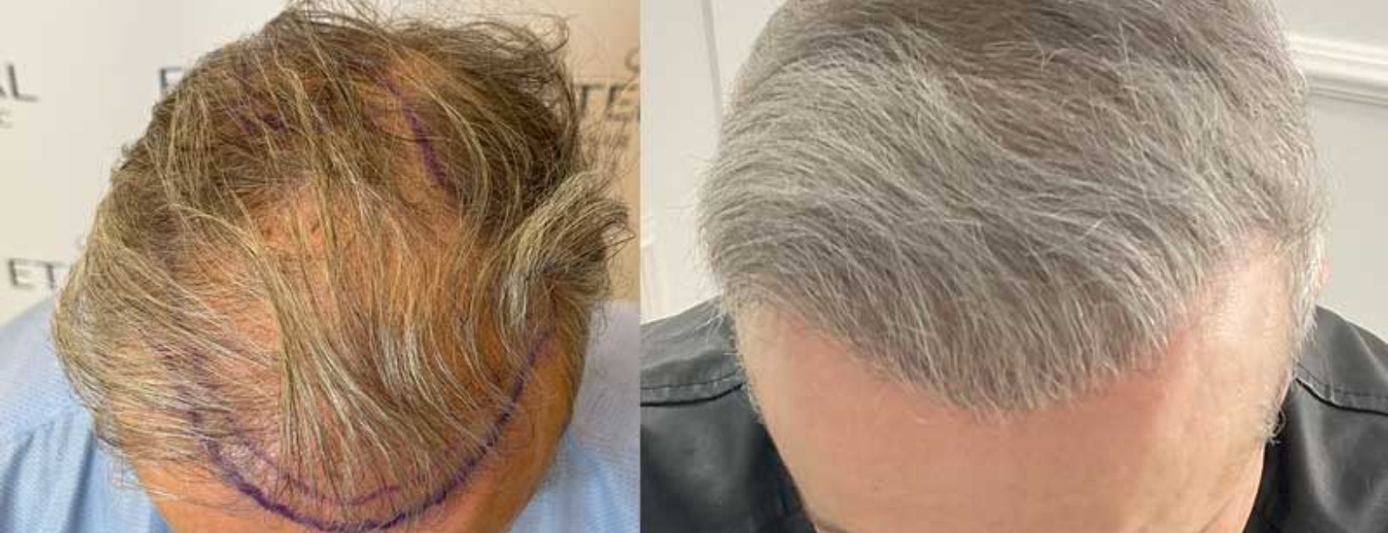 Foto de Eternal Hair Clinic en Barcelona - Imagen 3
