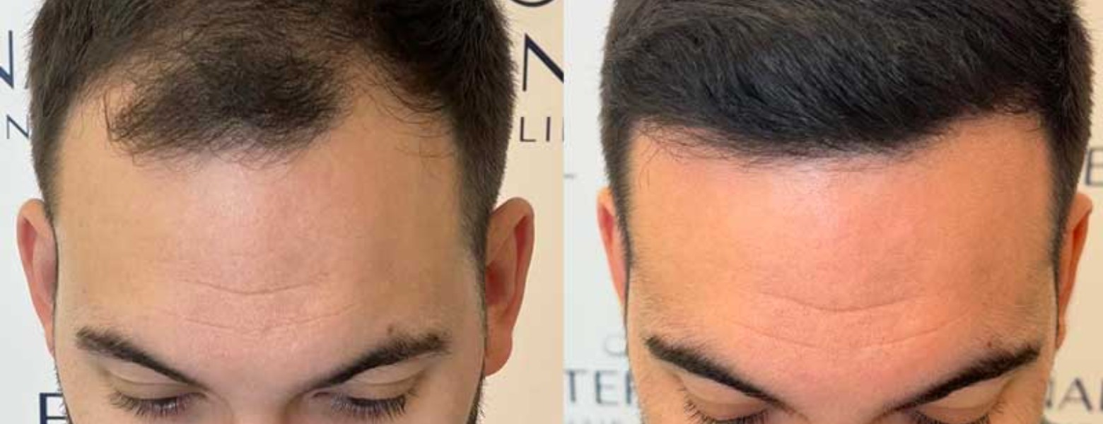 Foto de Eternal Hair Clinic en Barcelona - Imagen 4