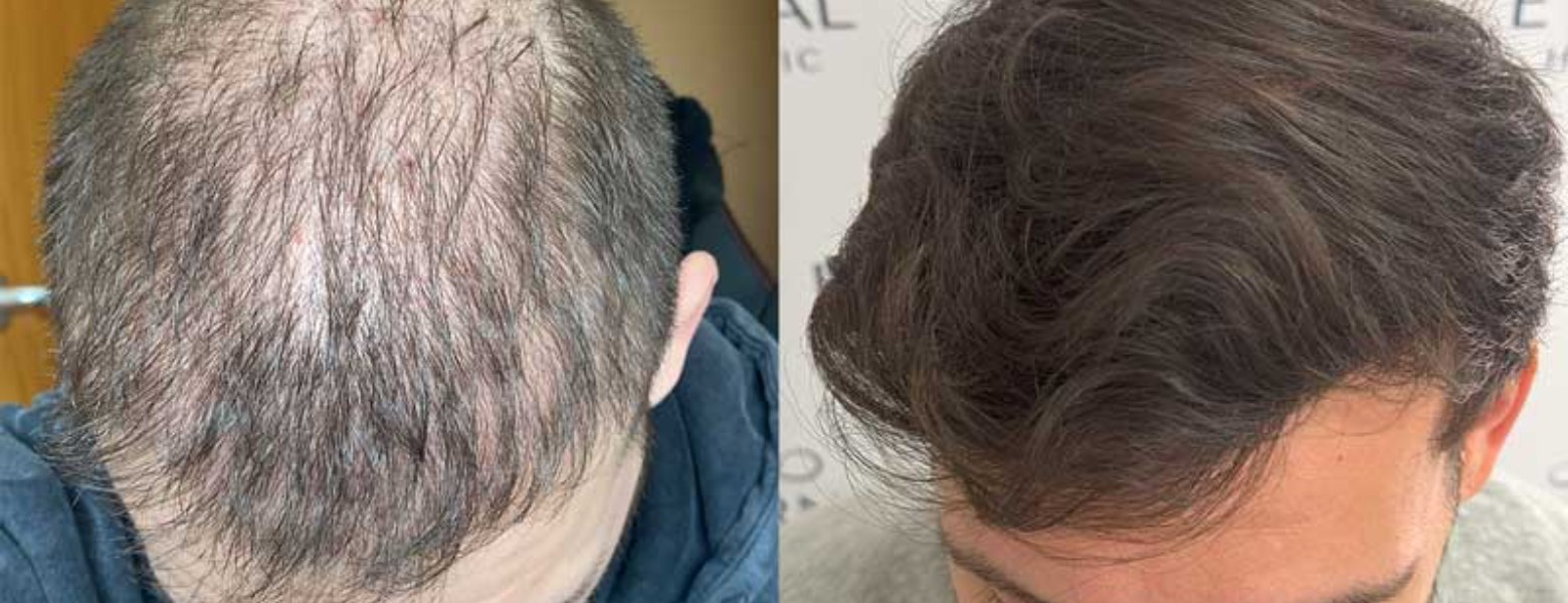 Foto de Eternal Hair Clinic en Barcelona - Imagen 2
